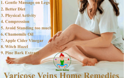 Varicose Veins Home Remedies, Ayurveda Treatment,